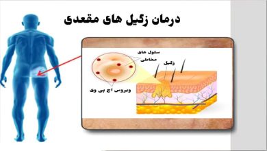 پیشگیری از زگیل‌های تناسلی