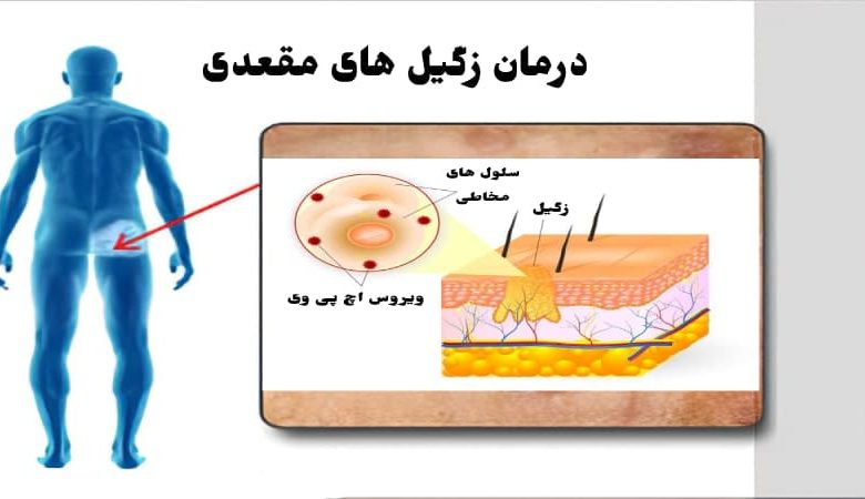 پیشگیری از زگیل‌های تناسلی