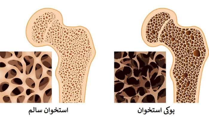 نحوه استفاده از قرص کلسیم برای پیشگیری از کاهش پوکی استخوان