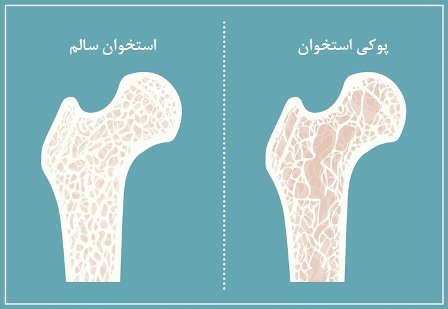 نحوه استفاده از قرص کلسیم برای پیشگیری از کاهش پوکی استخوان