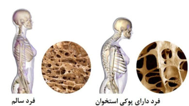 نحوه استفاده از قرص کلسیم برای پیشگیری از کاهش استخوان