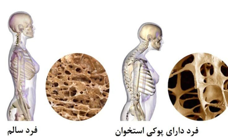 نحوه استفاده از قرص کلسیم برای پیشگیری از کاهش استخوان