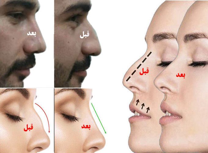 چسب لیفت بینی